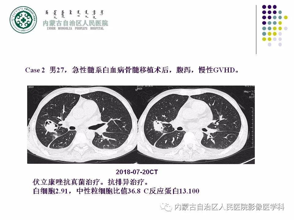 影像PPT - 【PPT】肺空洞性病变鉴别诊断-55