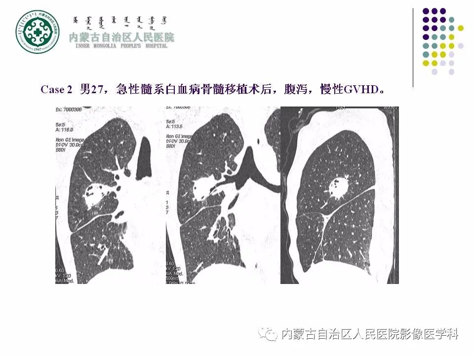影像PPT - 【PPT】肺空洞性病变鉴别诊断-56