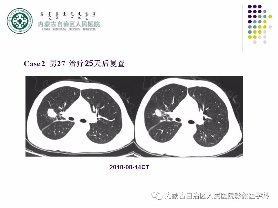 影像PPT - 【PPT】肺空洞性病变鉴别诊断-57