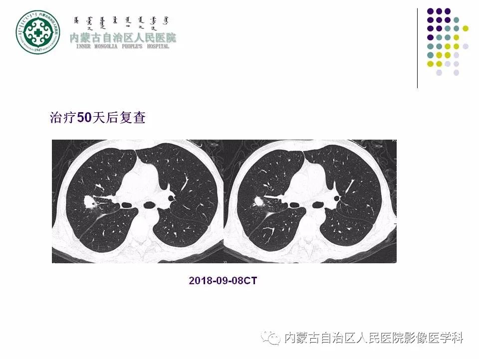 影像PPT - 【PPT】肺空洞性病变鉴别诊断-58