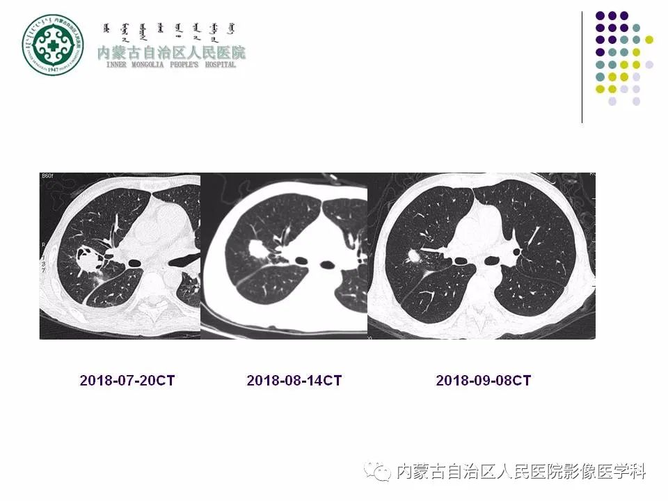 影像PPT - 【PPT】肺空洞性病变鉴别诊断-59