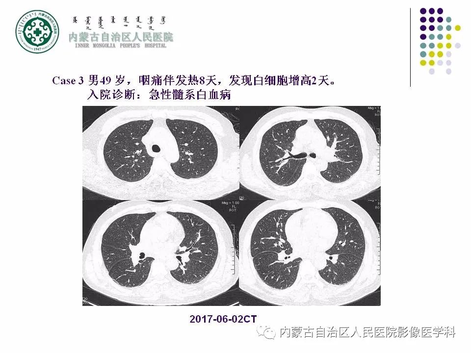 影像PPT - 【PPT】肺空洞性病变鉴别诊断-60
