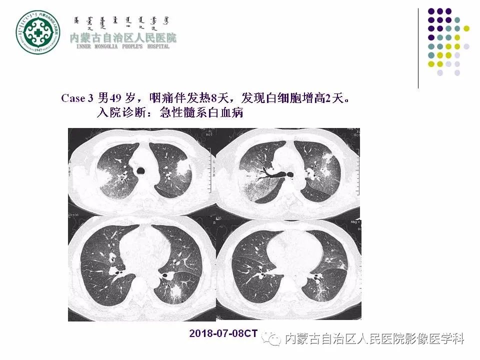 影像PPT - 【PPT】肺空洞性病变鉴别诊断-61