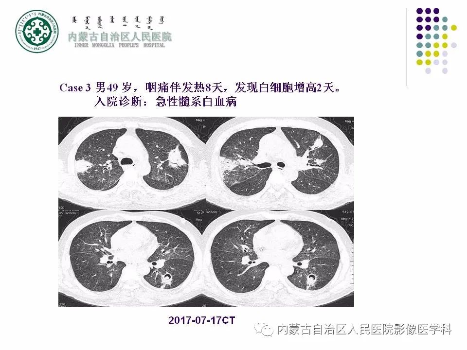 影像PPT - 【PPT】肺空洞性病变鉴别诊断-62