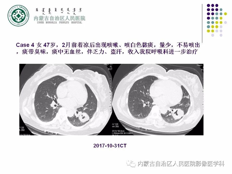 影像PPT - 【PPT】肺空洞性病变鉴别诊断-63