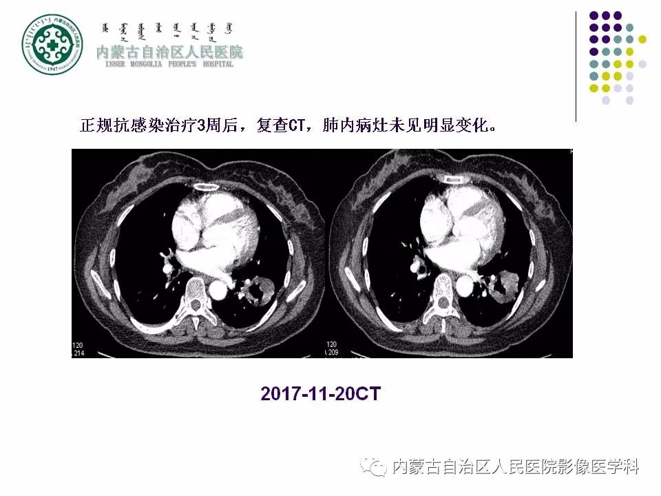 影像PPT - 【PPT】肺空洞性病变鉴别诊断-64
