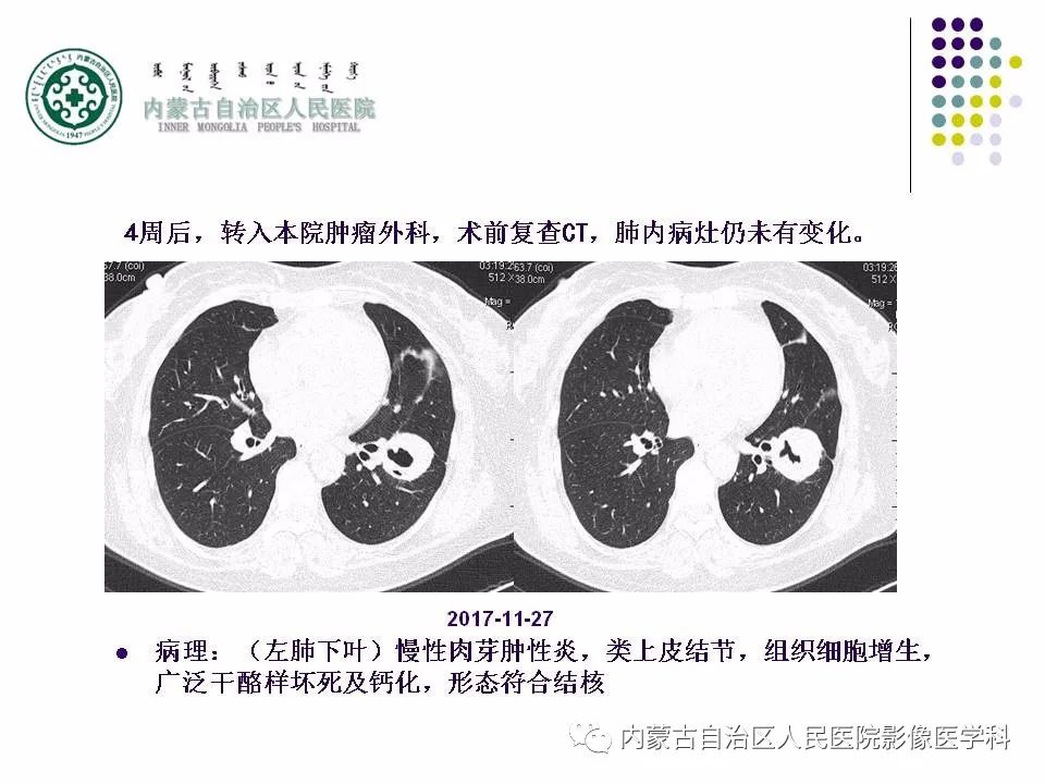 影像PPT - 【PPT】肺空洞性病变鉴别诊断-65