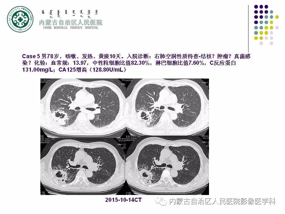 影像PPT - 【PPT】肺空洞性病变鉴别诊断-66