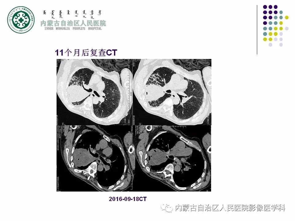 影像PPT - 【PPT】肺空洞性病变鉴别诊断-67