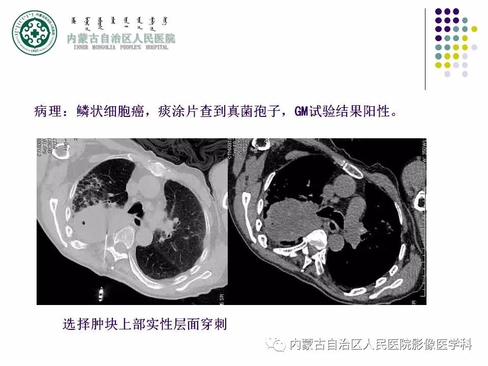影像PPT - 【PPT】肺空洞性病变鉴别诊断-68