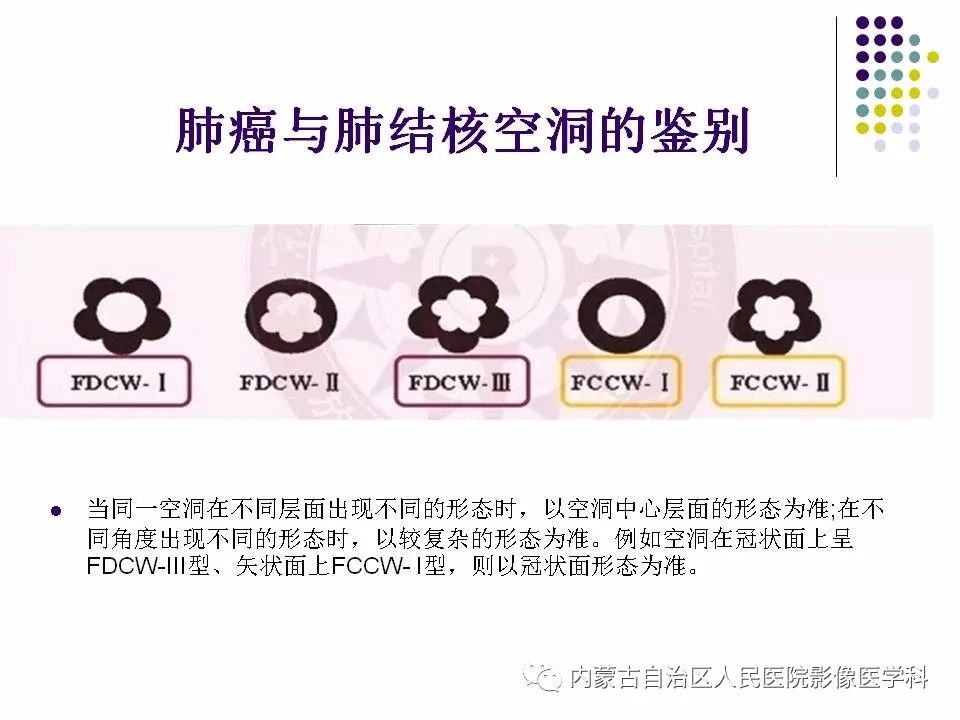 影像PPT - 【PPT】肺空洞性病变鉴别诊断-70