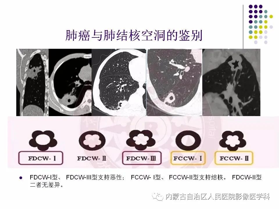 影像PPT - 【PPT】肺空洞性病变鉴别诊断-71