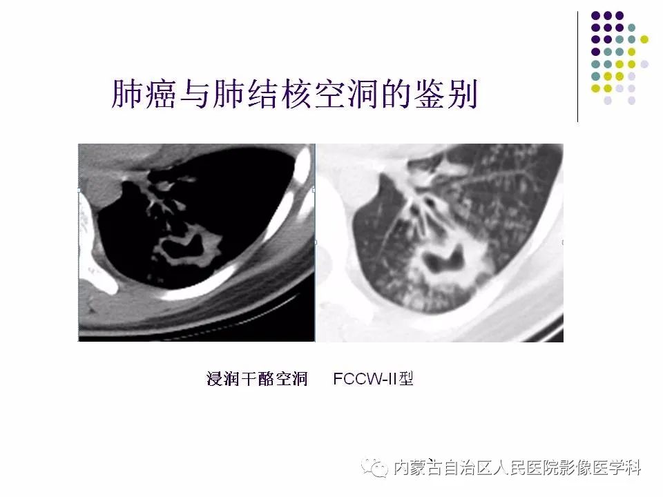 影像PPT - 【PPT】肺空洞性病变鉴别诊断-72