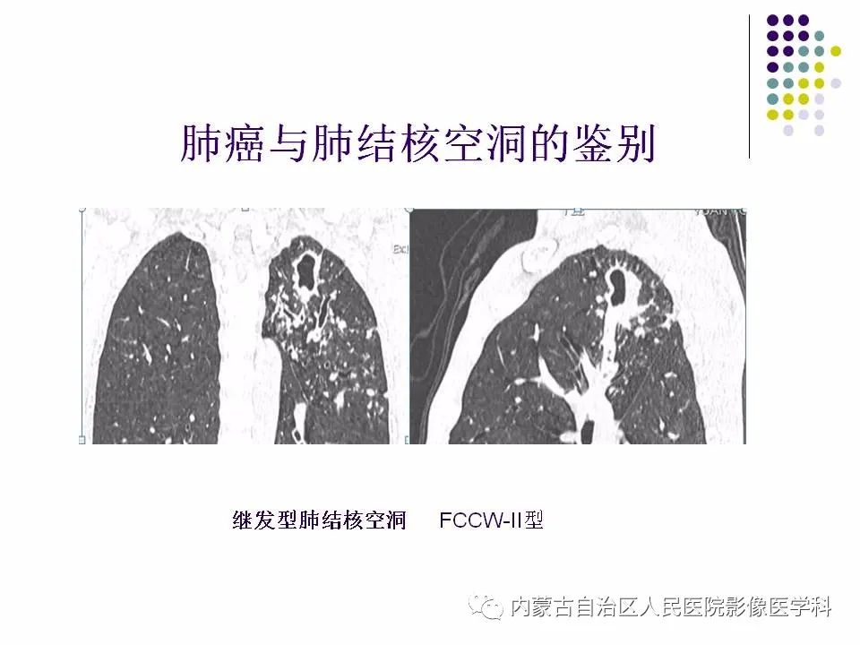 影像PPT - 【PPT】肺空洞性病变鉴别诊断-73