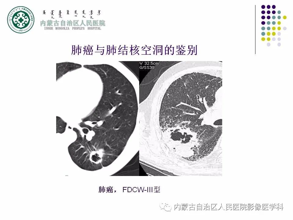 影像PPT - 【PPT】肺空洞性病变鉴别诊断-74