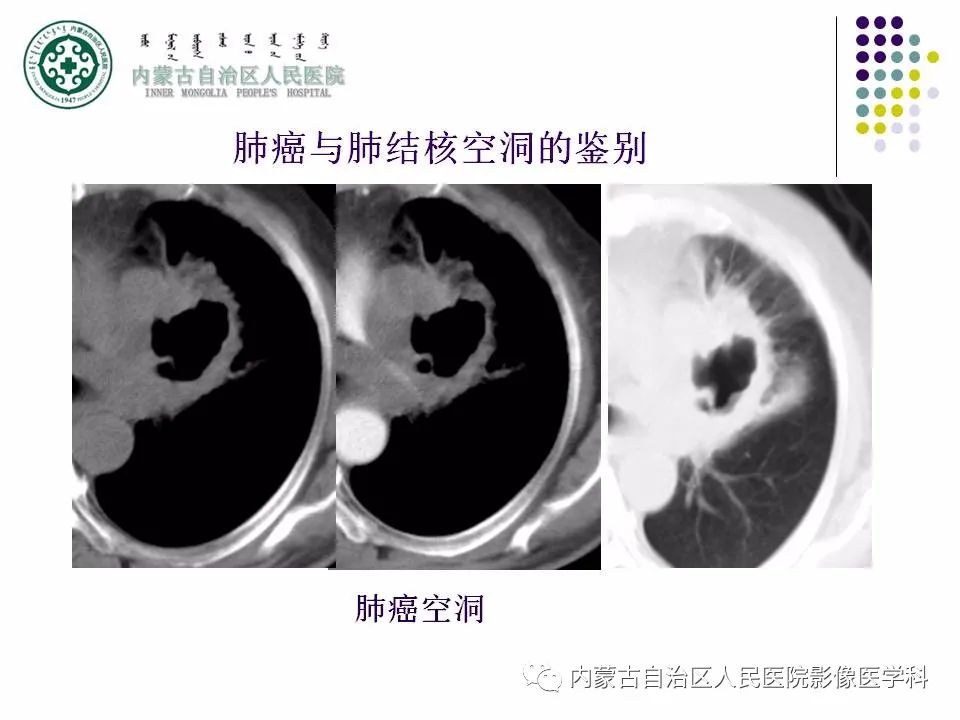 影像PPT - 【PPT】肺空洞性病变鉴别诊断-75