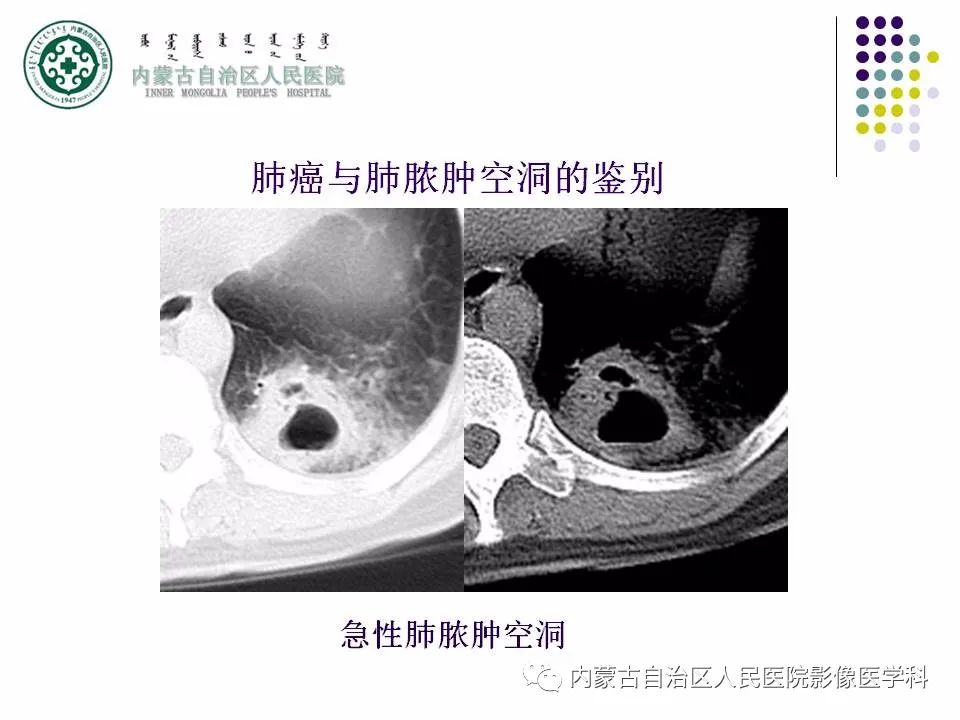 影像PPT - 【PPT】肺空洞性病变鉴别诊断-76