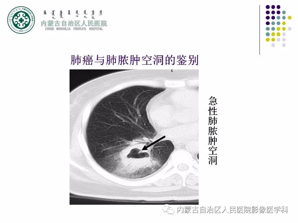 影像PPT - 【PPT】肺空洞性病变鉴别诊断-77