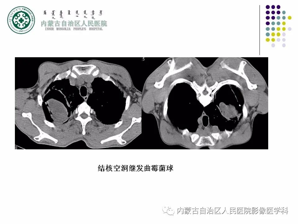 影像PPT - 【PPT】肺空洞性病变鉴别诊断-79