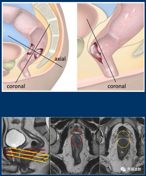 影像PPT - 直肠癌MRI-1 影像PPT - 直肠癌MRI-1