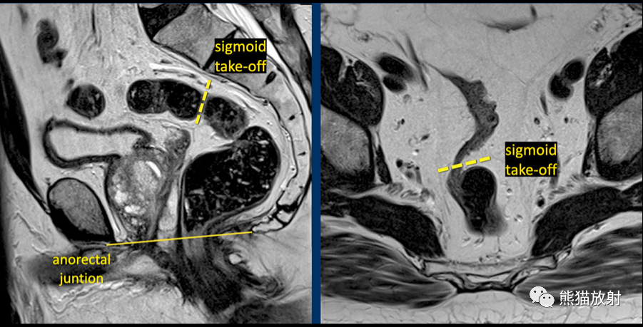 影像PPT - 直肠癌MRI-7 影像PPT - 直肠癌MRI-7