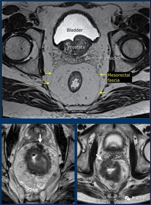 影像PPT - 直肠癌MRI-13 影像PPT - 直肠癌MRI-13