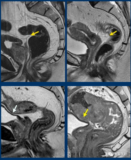 影像PPT - 直肠癌MRI-15 影像PPT - 直肠癌MRI-15