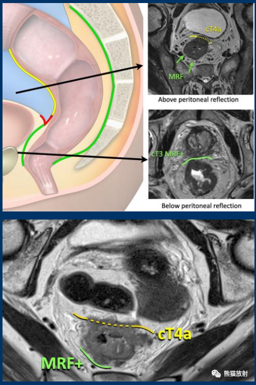 影像PPT - 直肠癌MRI-16 影像PPT - 直肠癌MRI-16
