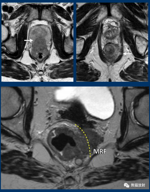 影像PPT - 直肠癌MRI-17 影像PPT - 直肠癌MRI-17