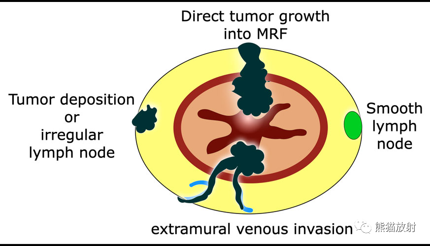 影像PPT - 直肠癌MRI-19 影像PPT - 直肠癌MRI-19