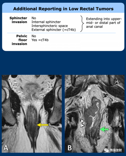 影像PPT - 直肠癌MRI-21 影像PPT - 直肠癌MRI-21
