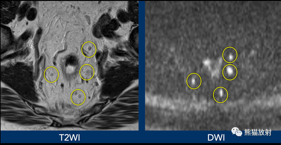 影像PPT - 直肠癌MRI-25 影像PPT - 直肠癌MRI-25