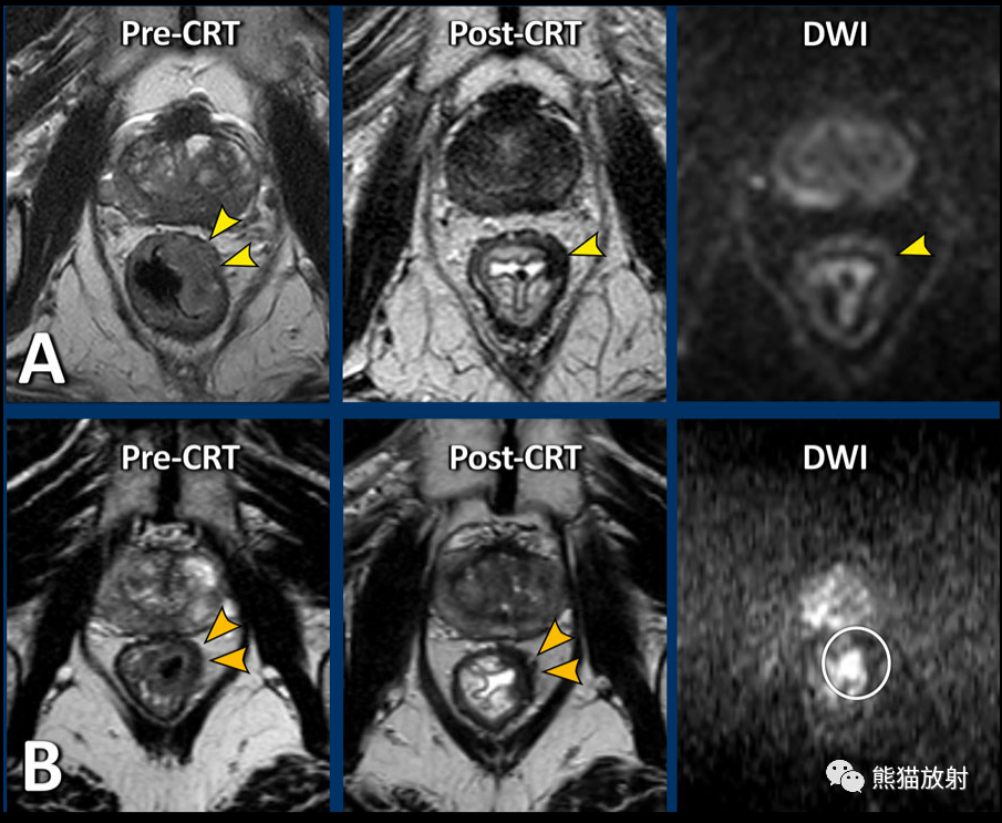 影像PPT - 直肠癌MRI-26 影像PPT - 直肠癌MRI-26