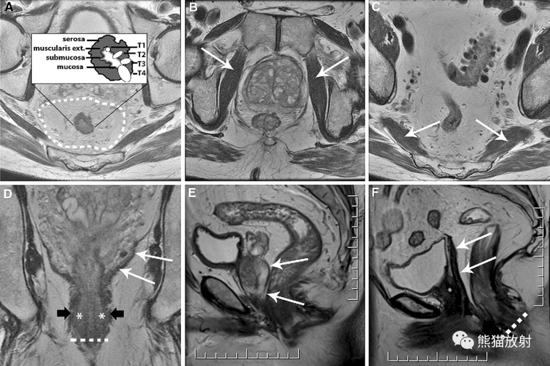 影像PPT - 直肠癌MRI-28 影像PPT - 直肠癌MRI-28
