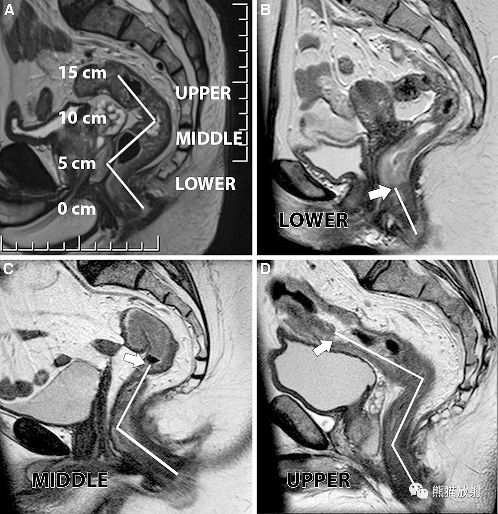 影像PPT - 直肠癌MRI-29 影像PPT - 直肠癌MRI-29