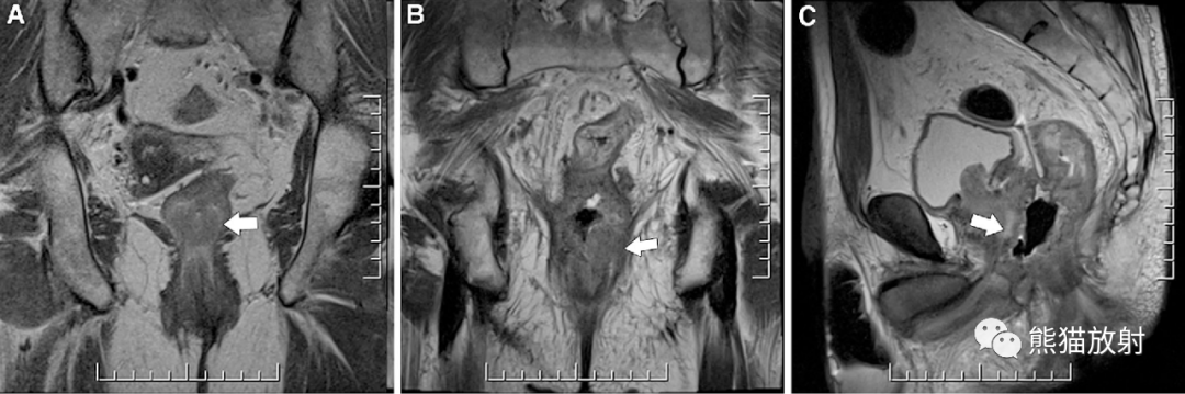影像PPT - 直肠癌MRI-31 影像PPT - 直肠癌MRI-31