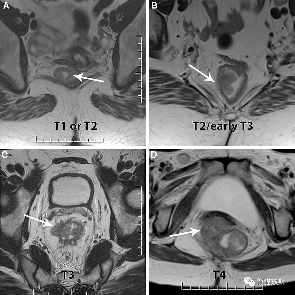 影像PPT - 直肠癌MRI-30 影像PPT - 直肠癌MRI-30