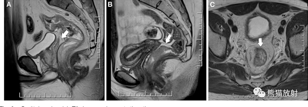 影像PPT - 直肠癌MRI-32 影像PPT - 直肠癌MRI-32