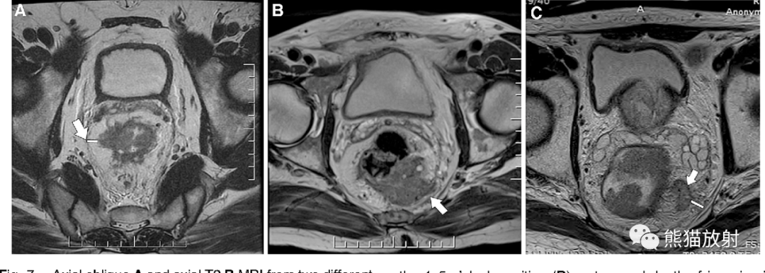 影像PPT - 直肠癌MRI-33 影像PPT - 直肠癌MRI-33