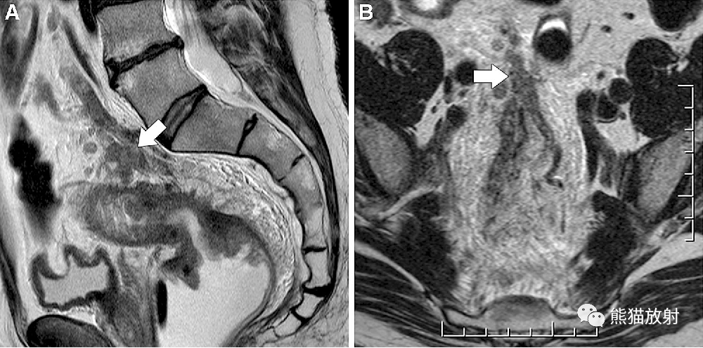 影像PPT - 直肠癌MRI-34 影像PPT - 直肠癌MRI-34