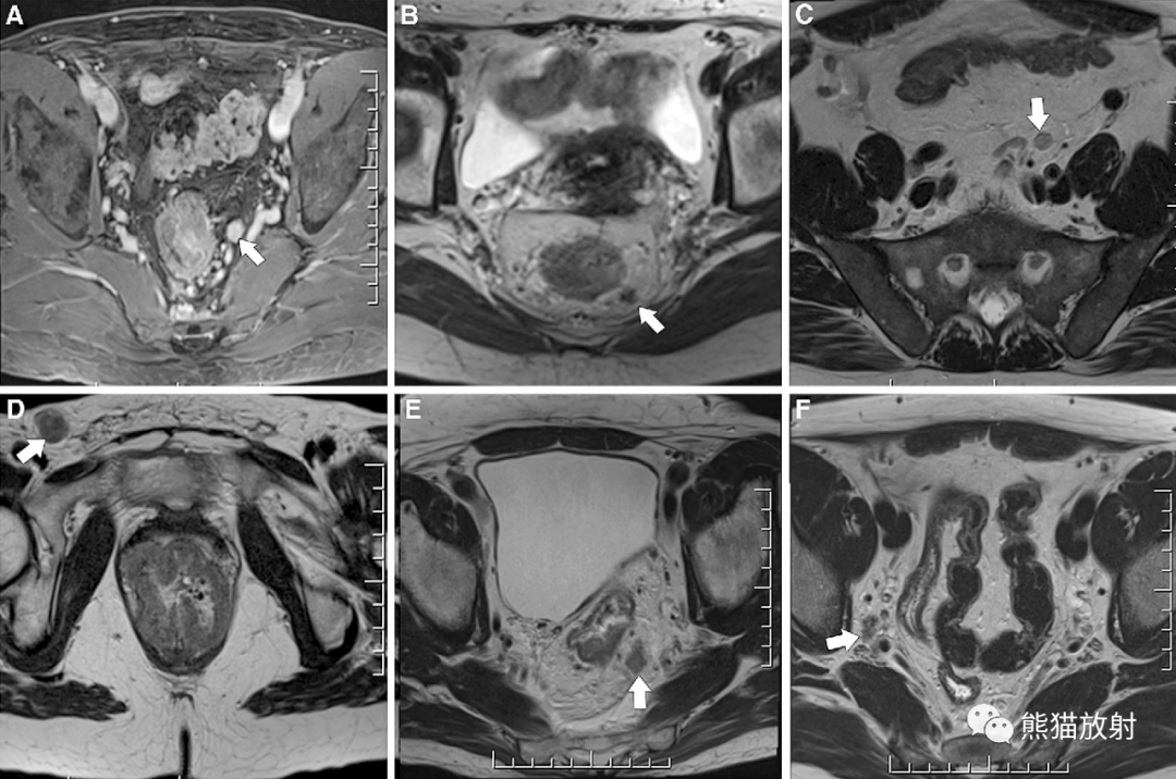 影像PPT - 直肠癌MRI-35 影像PPT - 直肠癌MRI-35