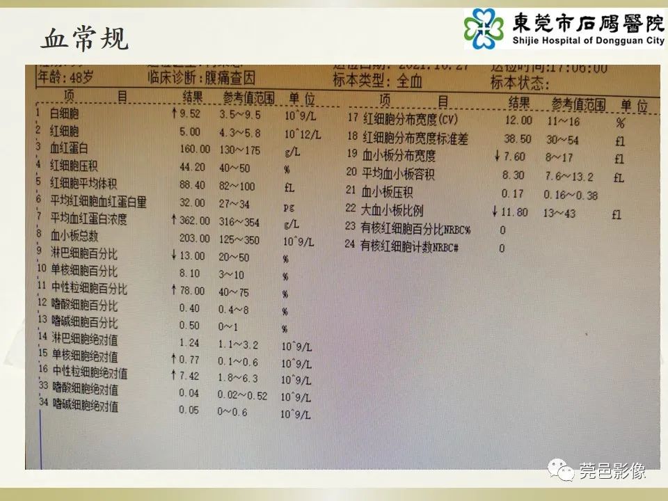 影像PPT - 【PPT】异位阑尾炎的CT诊断-3