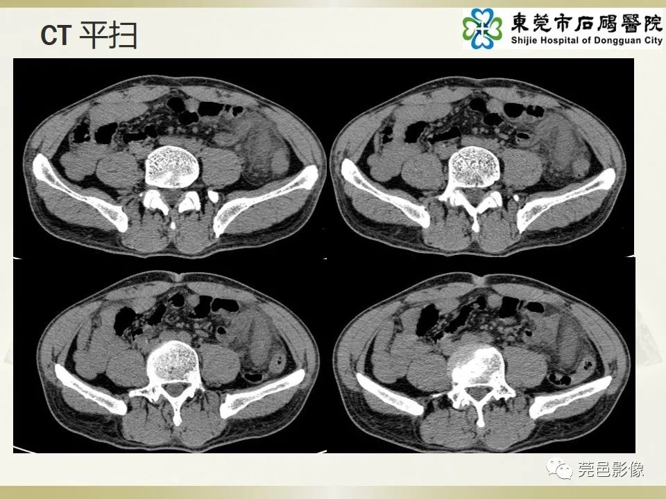 影像PPT - 【PPT】异位阑尾炎的CT诊断-4