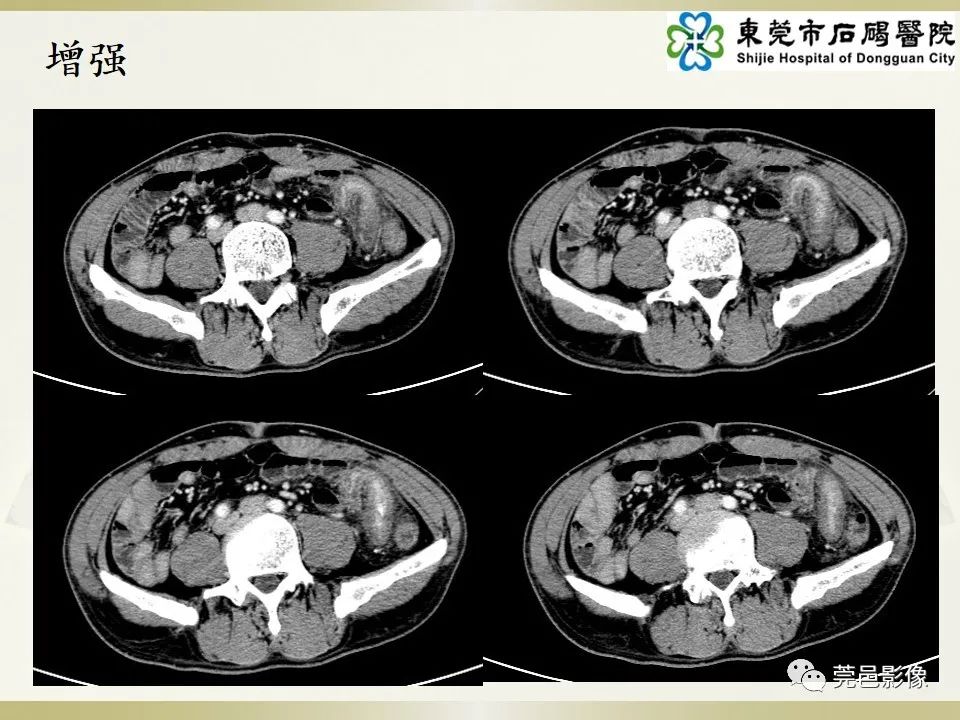 影像PPT - 【PPT】异位阑尾炎的CT诊断-5