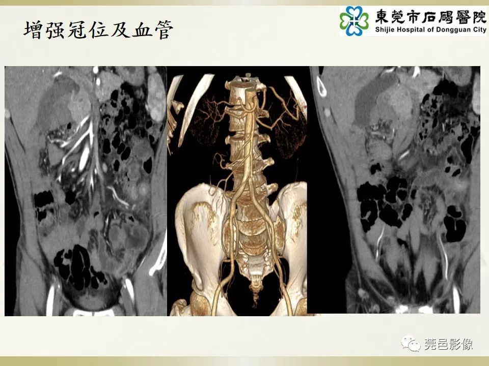 影像PPT - 【PPT】异位阑尾炎的CT诊断-6