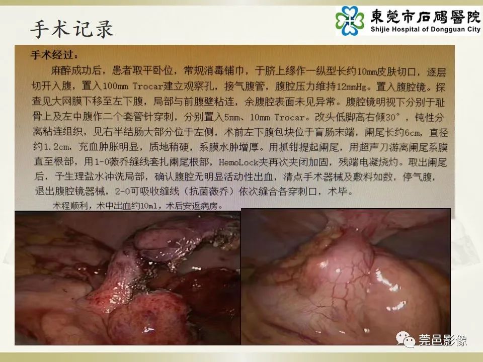 影像PPT - 【PPT】异位阑尾炎的CT诊断-7
