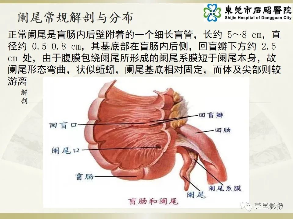 影像PPT - 【PPT】异位阑尾炎的CT诊断-10