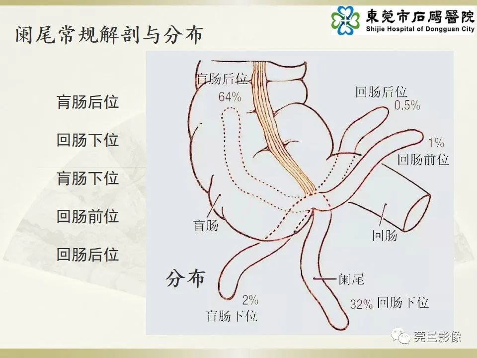 影像PPT - 【PPT】异位阑尾炎的CT诊断-11