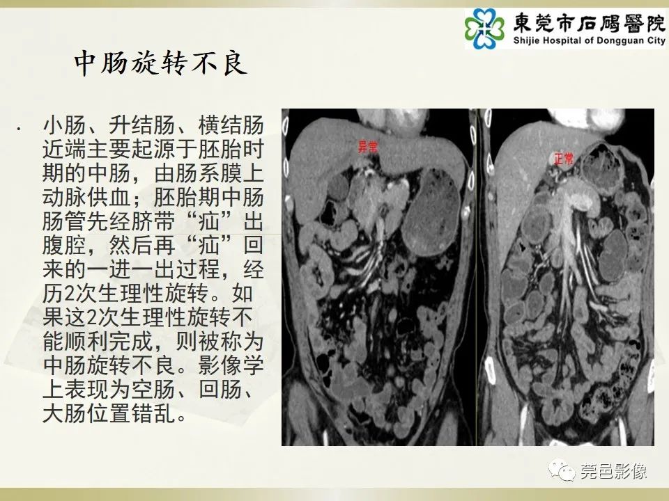 影像PPT - 【PPT】异位阑尾炎的CT诊断-13