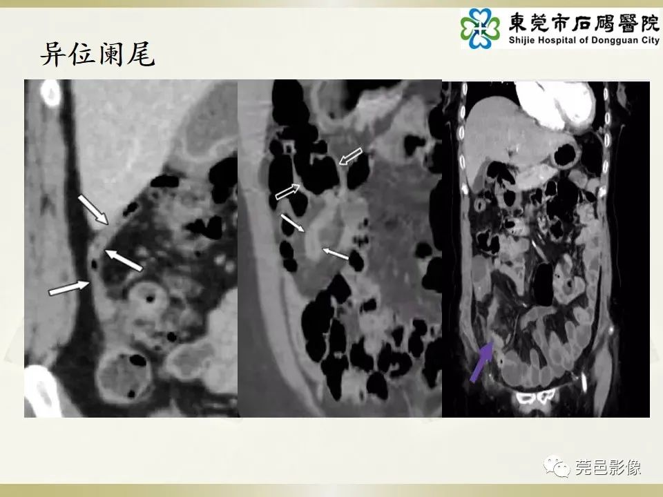 影像PPT - 【PPT】异位阑尾炎的CT诊断-15